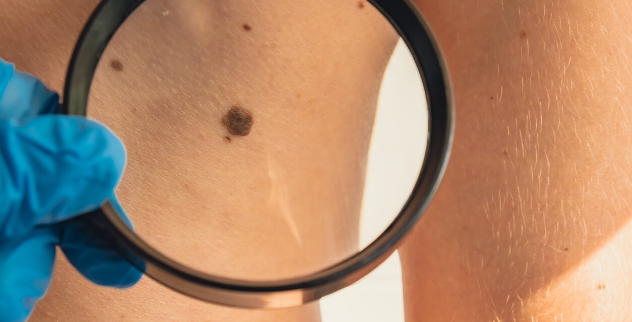 Cáncer de Piel: Cómo detectar los primeros signos en tu piel